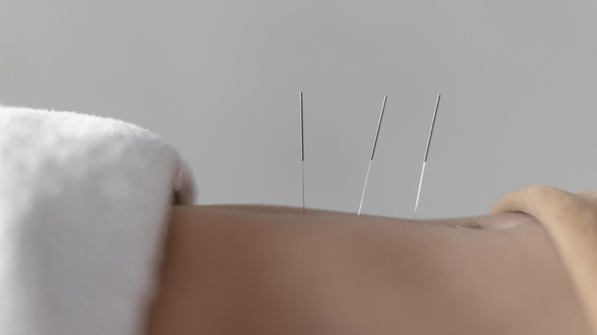 acupuncture copy